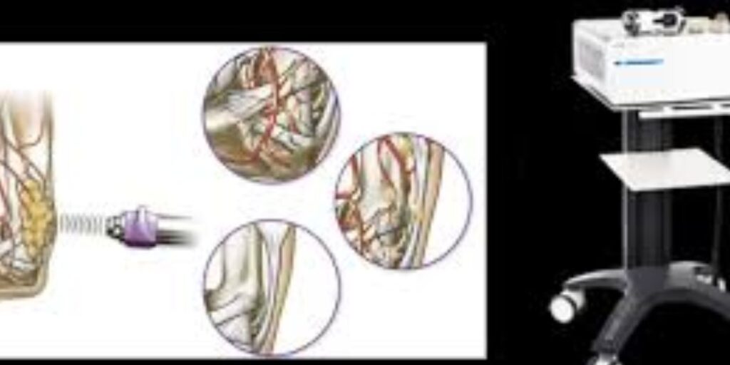 PST for Osteoarthritis and Cartilage Regeneration